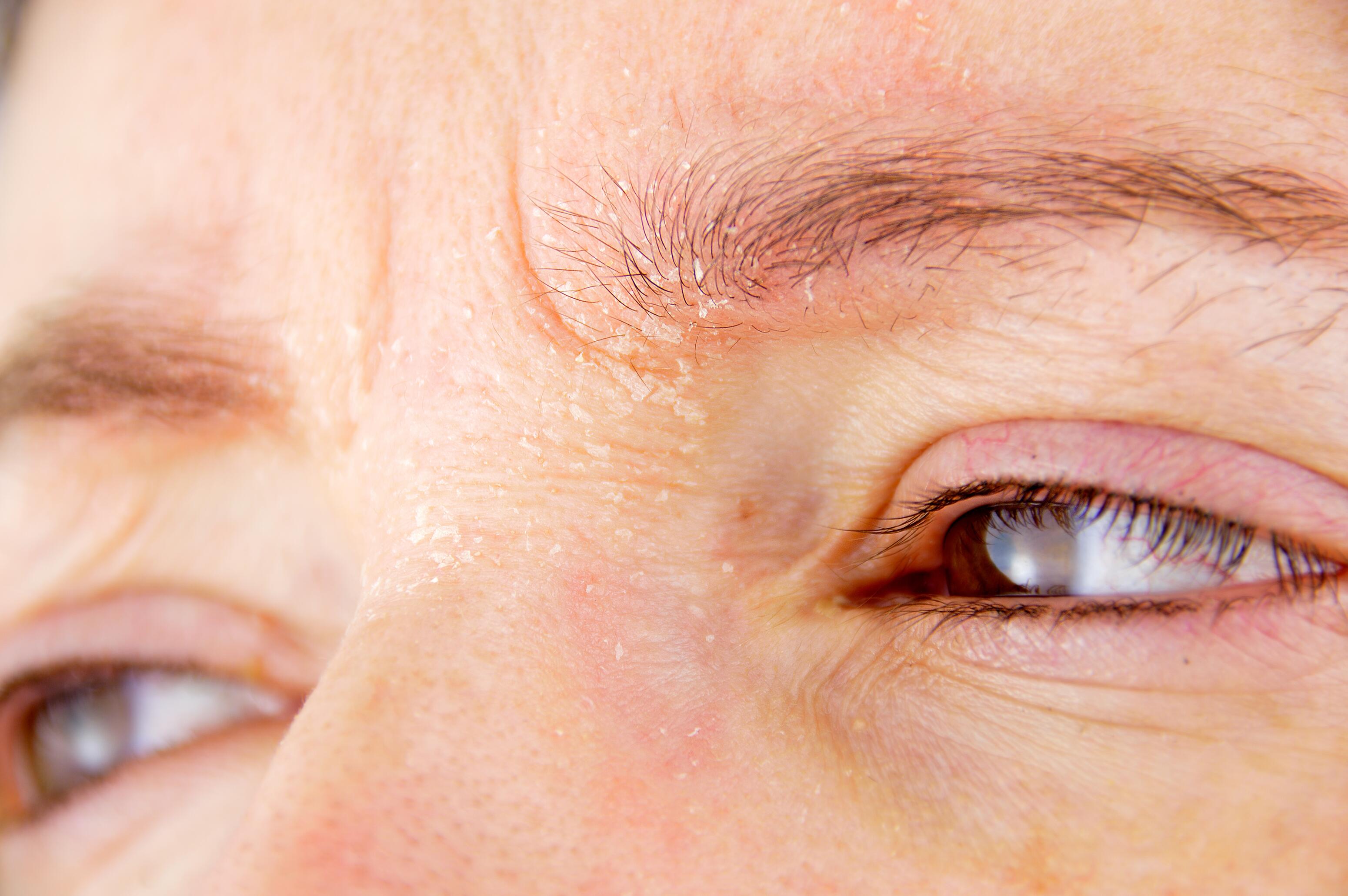 Homme avec pellicules dans les sourcils